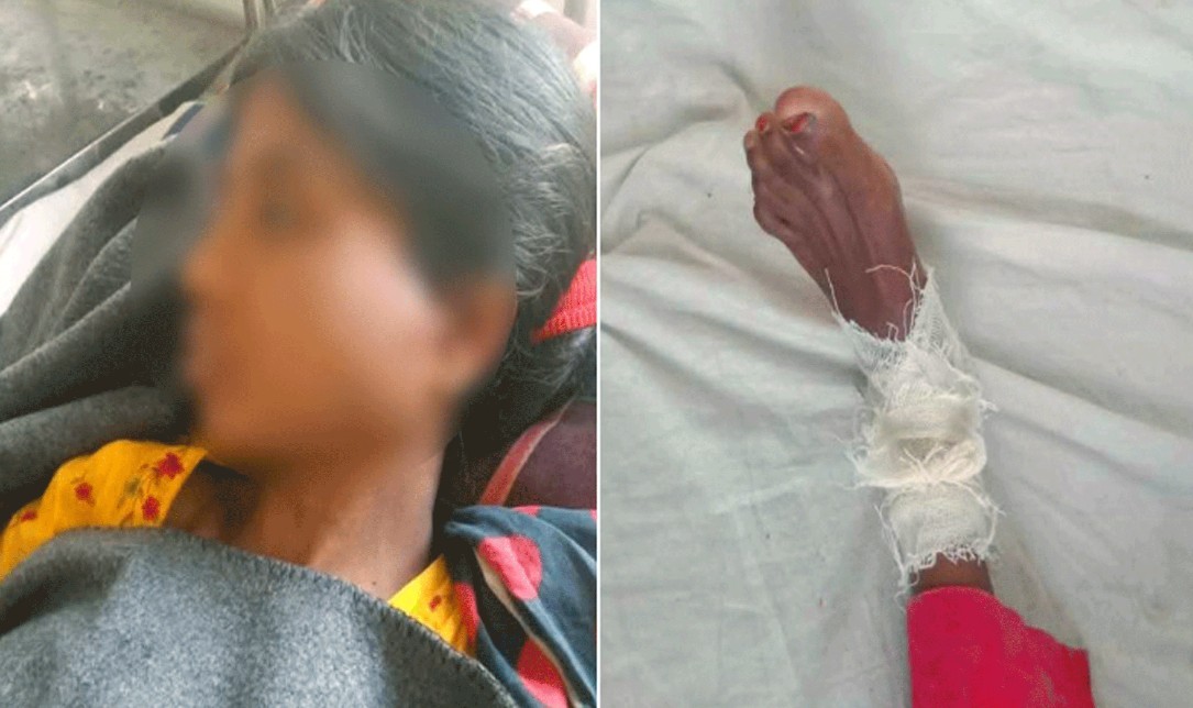 স্ত্রীকে মুখে ছ্যাঁকা দিয়ে পায়ের রগ কেটে দিলেন স্বামী